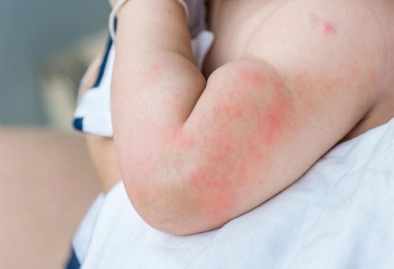 Paediatric Dermatologist in Singapore: Understanding Skin-Food Allergies in Children