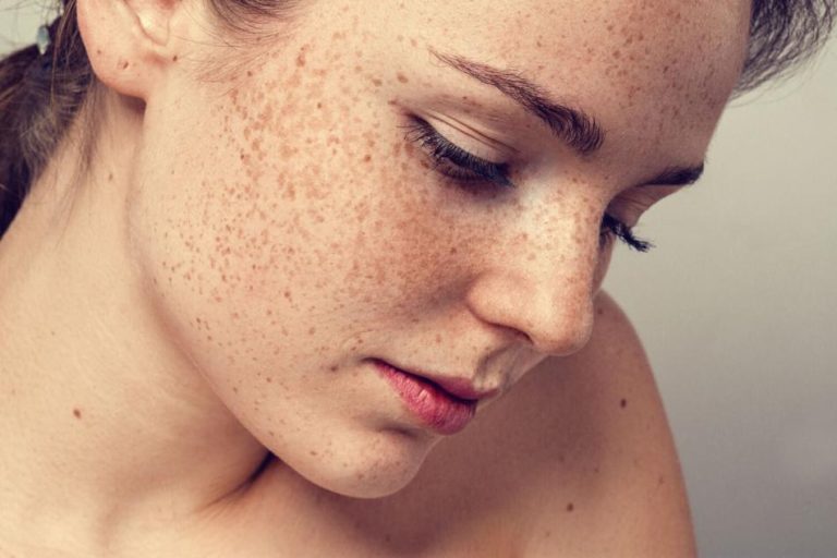 Pigmentation: Understanding the Causes, Treatments, and Solutions